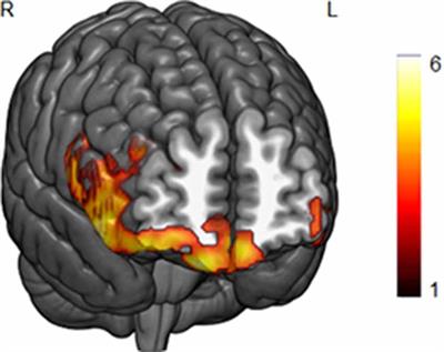 Individual Differences in Hippocampal Volume as a Function of BMI and Reward Sensitivity